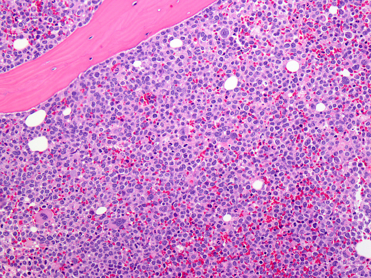 Primitive cells showed granular eosinophilic cytoplasm and irregular, often lobated nuclei (H&E).